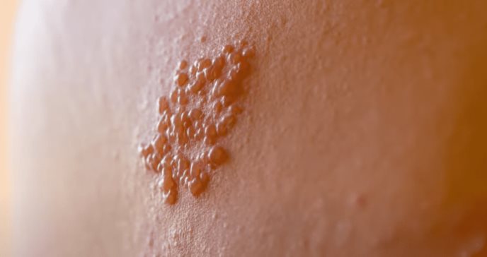 Herpes Zóster: la famosa culebrilla una enfermedad cutánea y dolorosa