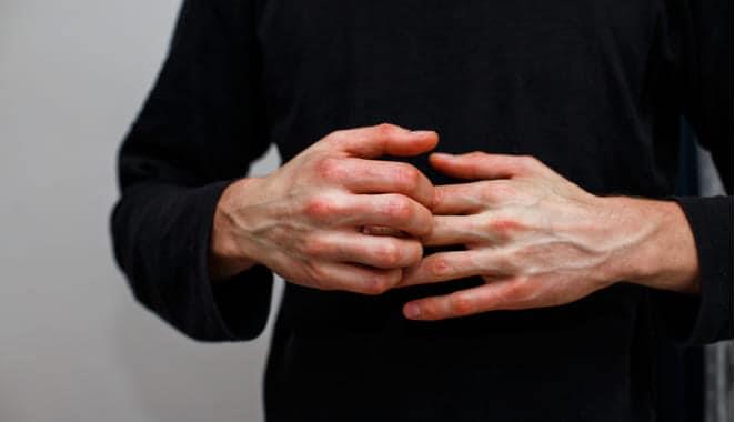 Rompiendo barreras para el paciente de psoriasis
