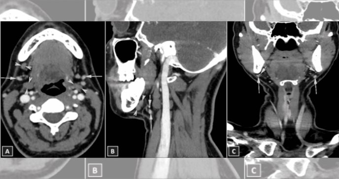 Describen raro caso de aplasia bilateral de la glándula submandibular
