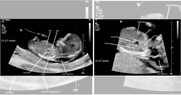 Ecografía transvaginal revela una hernia diafragmática congénita en útero