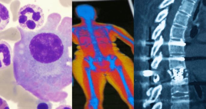 Obesidad aumenta la capacidad de proliferación del cáncer en pacientes con mieloma múltiple