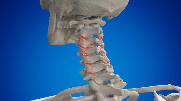 Artrosis cervical: ¿Un factor genético?