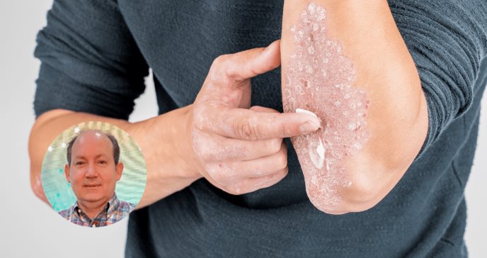 Exhortan a pacientes con psoriasis a actualizar su tratamiento, “no pierdan la esperanza”, Dr. Vendrell 