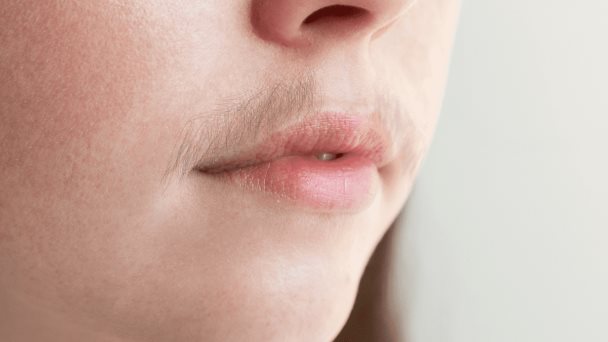 Hirsutismo, cuando el exceso de vello en la mujer puede ser una señal de varios problemas de salud