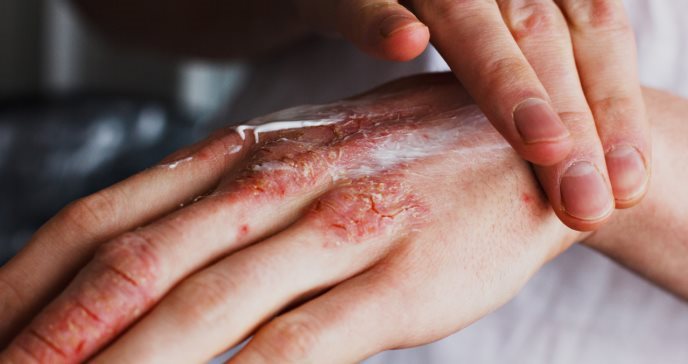 Hidratación de la piel y adherencia al tratamiento, claves para evitar la exacerbación del eccema