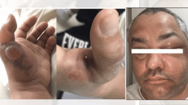 Primer caso de mordedura de viuda negra y la peligrosa inflamación eritematosa en paciente puertorriqueño Primer caso de mordedura de viuda negra y la peligrosa inflamación eritematosa en paciente puertorriqueño
