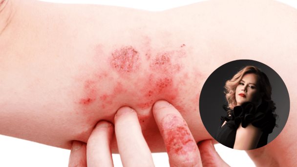 “Hay que tener esperanza”: Lee Nieves, paciente que superó la dermatitis atópica “Hay que tener esperanza”: Lee Nieves, paciente que superó la dermatitis atópica