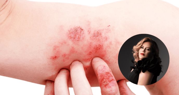 “Hay que tener esperanza”: Lee Nieves, paciente que superó la dermatitis atópica