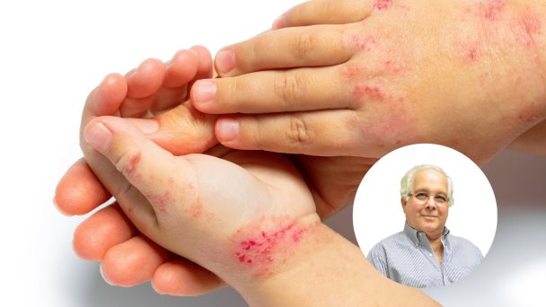 Dermatitis Atópica altamente prevalente en Puerto Rico: un 10 a 12 % de la población lo padece Dermatitis Atópica altamente prevalente en Puerto Rico: un 10 a 12 % de la población lo padece