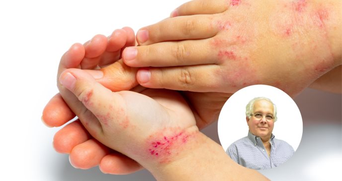 Dermatitis Atópica altamente prevalente en Puerto Rico: un 10 a 12 % de la población lo padece