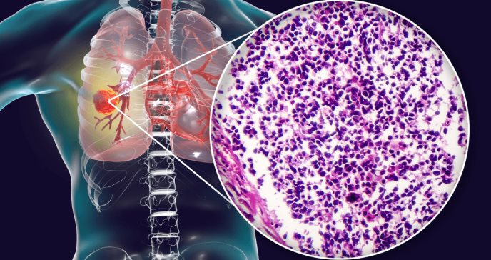 Terapia combinada en ratones demuestra potencial para detener el cáncer de pulmón de células pequeñas