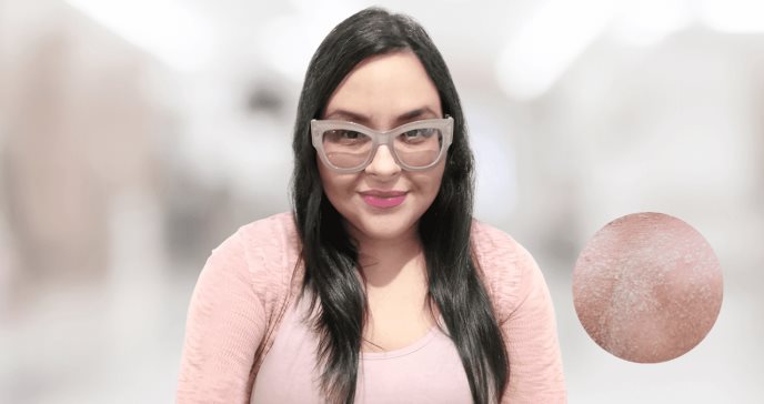 Ketsy Román: la puertorriqueña que creó un grupo de apoyo para los pacientes con dermatitis atópica