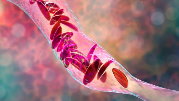 ¿Qué causa la anemia y cómo detectar sus síntomas? ¿Qué causa la anemia y cómo detectar sus síntomas?