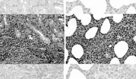 Descubren linfoma MALT gástrico en médula ósea con apariencia de mieloma