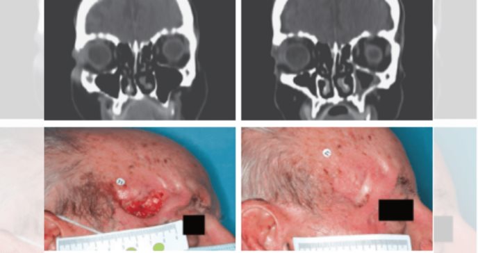 Terapia con cemiplimab se asoció a mejora completa en pacientes con carcinoma epidermoide cutáneo
