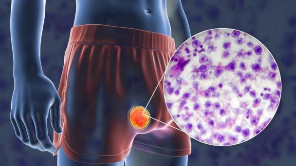 Hombre descubrió su diagnóstico de cáncer de testículo gracias a una cita erótica virtual