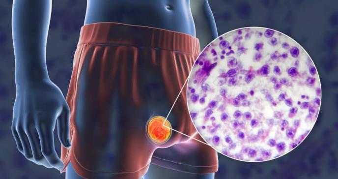 Hombre descubrió su diagnóstico de cáncer de testículo gracias a una cita erótica virtual