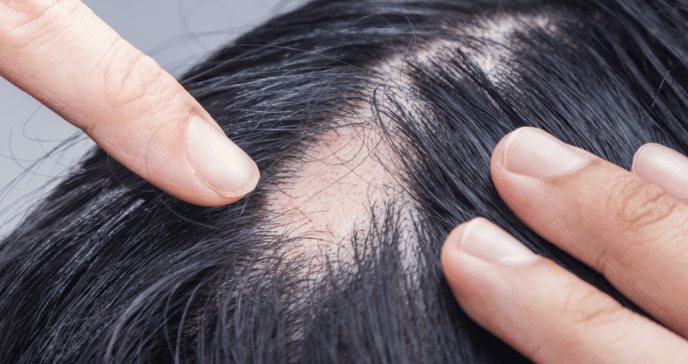 Necesaria la educación sobre Alopecia areata en Puerto Rico, según estudio
