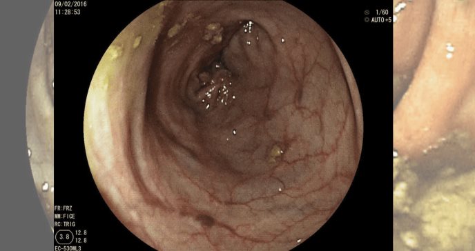 Factores que estarían llevando a desarrollar cáncer antes de los 50 años, según investigación