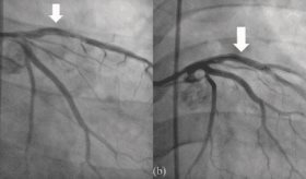 Joven puertorriqueño enfrenta infarto agudo con elevación del ST asociado síndrome antifosfolípido
