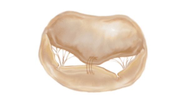 Reparo de la válvula mitral con egde to edge, uno de los mejores avances en la cardiología intervencional Reparo de la válvula mitral con egde to edge, uno de los mejores avances en la cardiología intervencional