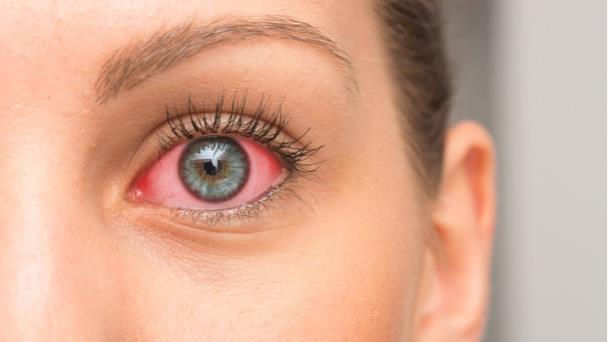 Escleritis, glaucoma, Sjögren: así es como la artritis afecta la vista Escleritis, glaucoma, Sjögren: así es como la artritis afecta la vista