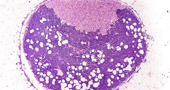La propagación metastásica del cáncer de mama se acelera durante el sueño
