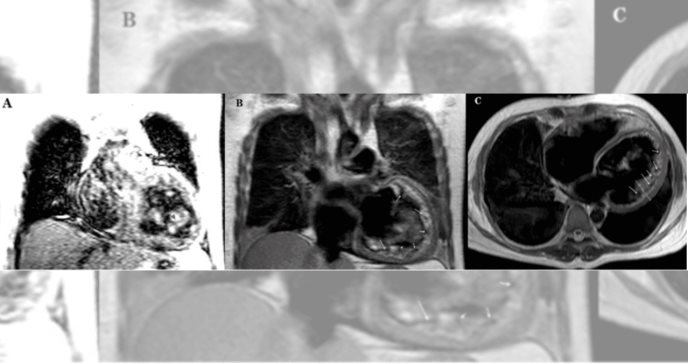 Necesario el diagnóstico oportuno de las miocardiopatías congénitas