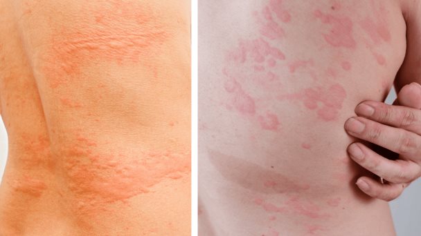 Urticaria aguda o crónica y el origen de las incómodas ronchas o habones generalizados en la piel Urticaria aguda o crónica y el origen de las incómodas ronchas o habones generalizados en la piel