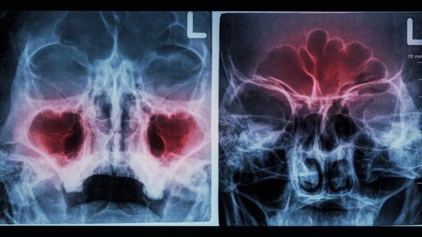 Reconozca los síntomas de la sinusitis y sus diferencias frente a la congestión nasal común Reconozca los síntomas de la sinusitis y sus diferencias frente a la congestión nasal común