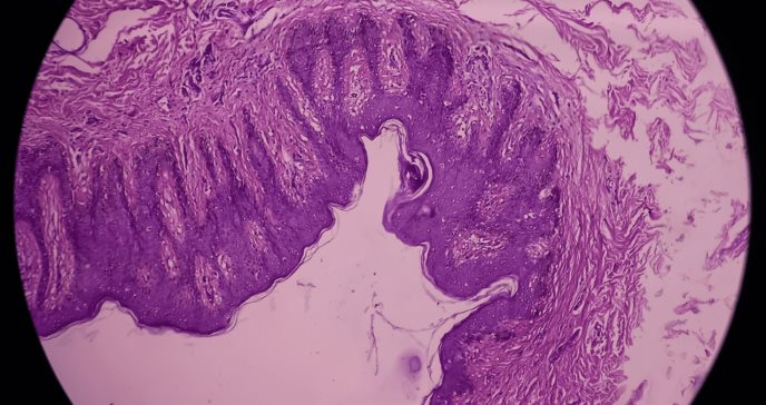 Estudios señalan que la endometriosis afecta más a pacientes con enfermedades autoinmunes e inflamatorias