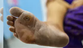 Conoce cómo evitar una amputación de pie diabético