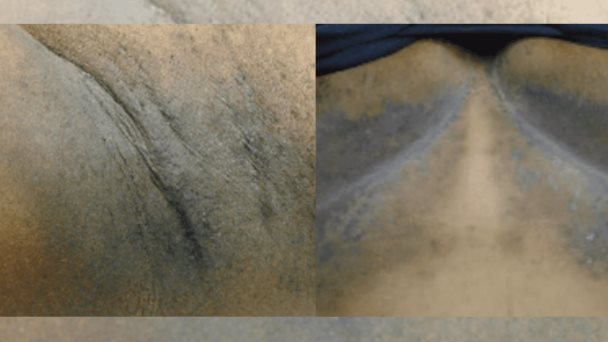 Revelan caso de Hidradenitis supurativa asociado con enfermedad de Galli-Galli y de Dowling-Degos Revelan caso de Hidradenitis supurativa asociado con enfermedad de Galli-Galli y de Dowling-Degos
