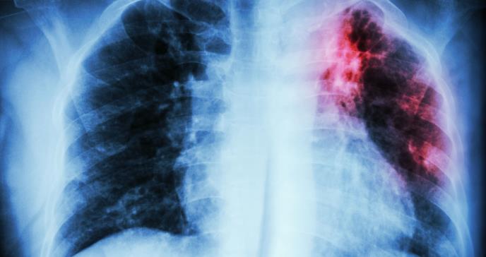 La neumonía intersticial usual en artritis reumatoide se asocia a mayor mortalidad