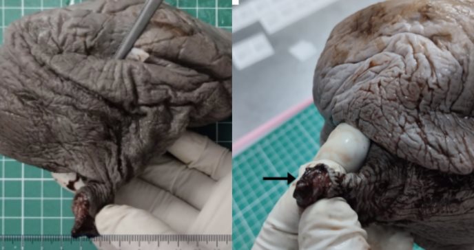 Enfatizan en la biopsia como principal método diagnóstico frente a rara neoplasia maligna en vulva