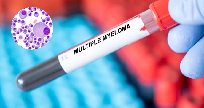 Avances de la medicina en la búsqueda de cura operacional para mieloma múltiple