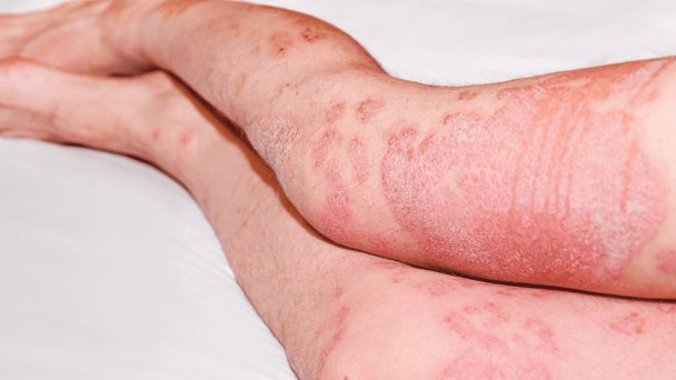 5 claves para el cuidado de la piel de los pacientes con artritis psoriásica 5 claves para el cuidado de la piel de los pacientes con artritis psoriásica
