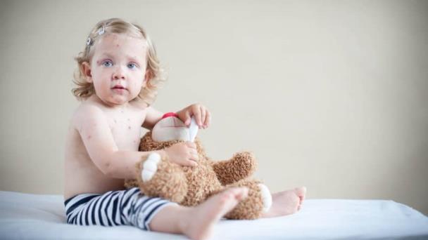 Foto galería de sarpullidos más frecuentes en los niños - Segunda parte