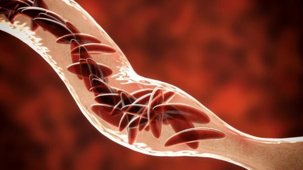 Estrategias de tratamiento para la enfermedad de células falciformes y la ß-talasemia Estrategias de tratamiento para la enfermedad de células falciformes y la ß-talasemia