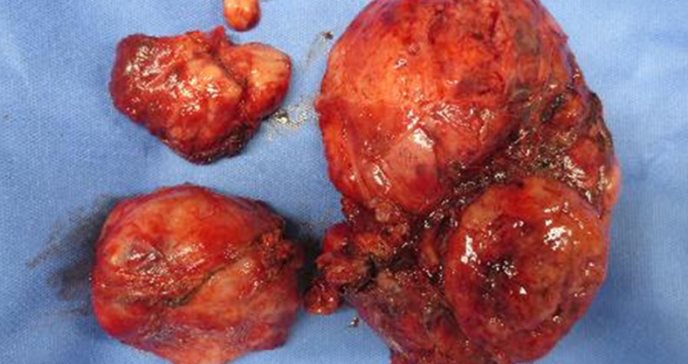 Exitoso tratamiento quirúrgico por tumor fibroso solitario pélvico acompañado de síndrome de Doege-Potter