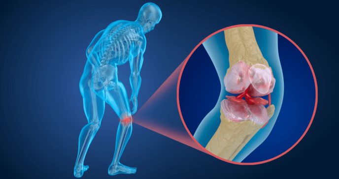 Hipertensión arterial podría aumentar envejecimiento óseo y riesgo de osteoporosis