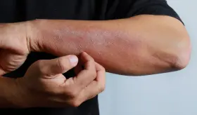 Las erupciones en la piel como s&iacute;ntoma temprano del Virus de Inmunodeficiencia Humana (VIH)