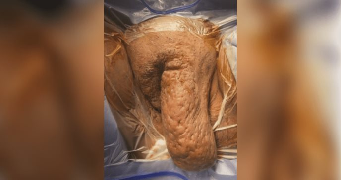 Raro caso de severa hidradenitis supurativa en el área vulvar