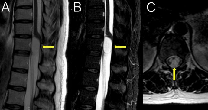 Laminectomía bilateral con durotomía como tratamiento para pacientes con quistes en la columna vertebral