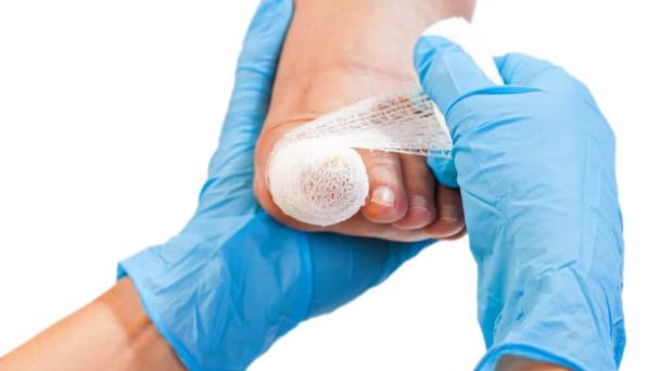 Uñas encarnadas en pacientes diabéticos: Enfoque de prevención y cuidado Uñas encarnadas en pacientes diabéticos: Enfoque de prevención y cuidado