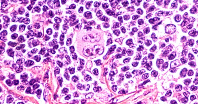 Mutación genética es clave en la aparición de linfomas y cáncer de pulmón, según estudio