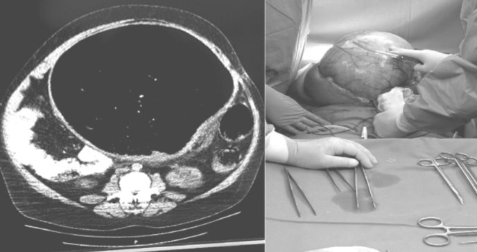 Cirugía y landiolol: vitales en el manejo de pacientes con sepsis y síndrome de Currarino