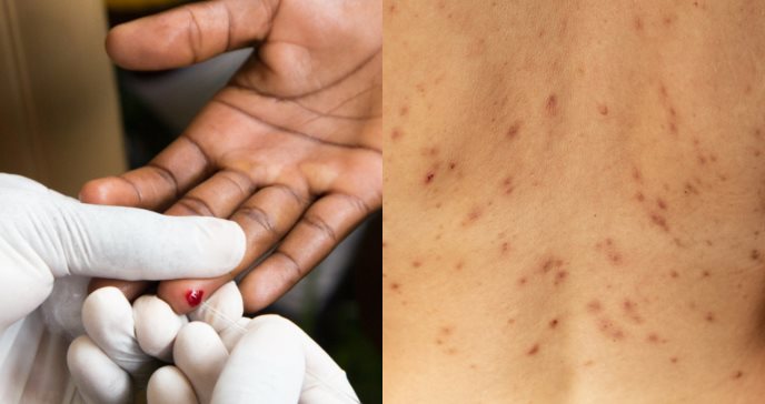 Infección por VIH podría contribuir al contagio por viruela del mono, según estudio