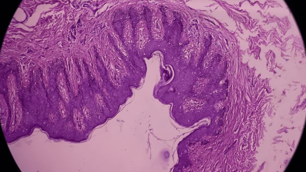Investigadores proponen un método no invasivo para tratar la endometriosis