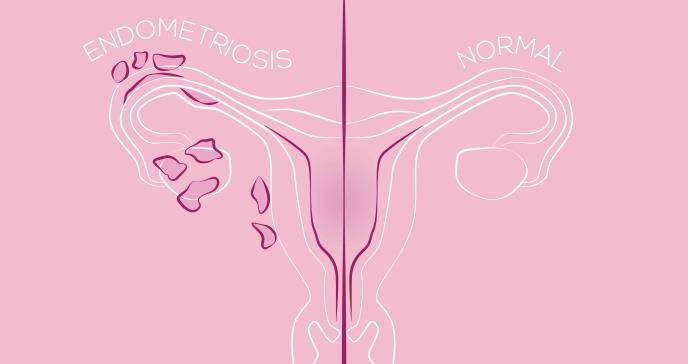 Actualizan guías para radioterapia del cáncer de endometrio